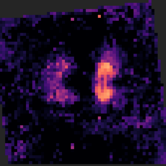 A visual anomaly heatmap produced by the DinoPatch work